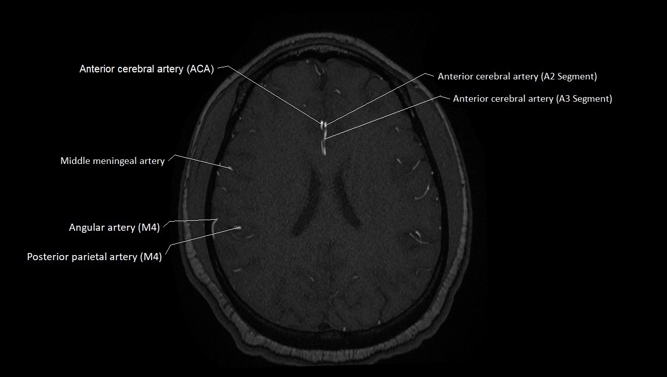 MRA brain (cerebral arteries) anatomy axial 3T image 39.webp